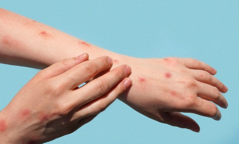 salud-descarta-transmision-local-de-sarampion-en-el-salvador